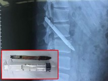 Lưỡi dao bị bỏ quên trong lưng chiến sỹ công an suốt 11 năm Lưỡi dao bị bỏ quên trong lưng chiến sỹ công an suốt 11 năm