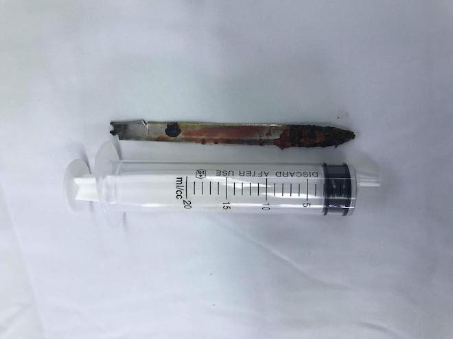 Lưỡi dao bị bỏ quên trong lưng chiến sỹ công an suốt 11 năm-4