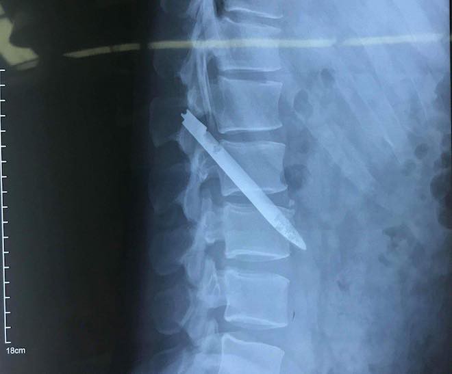 Lưỡi dao bị bỏ quên trong lưng chiến sỹ công an suốt 11 năm-3