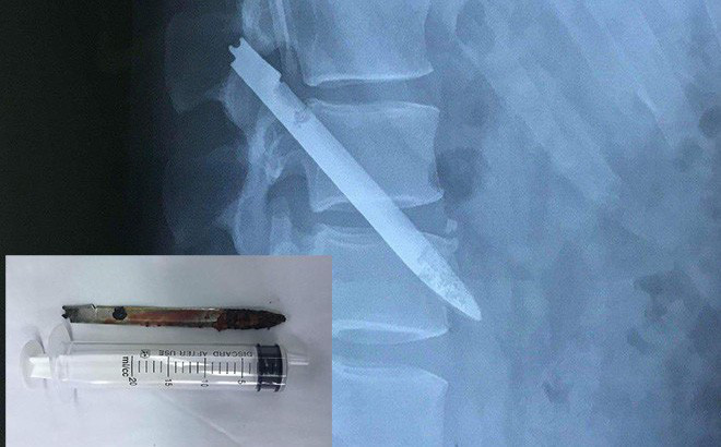 Lưỡi dao bị bỏ quên trong lưng chiến sỹ công an suốt 11 năm-1