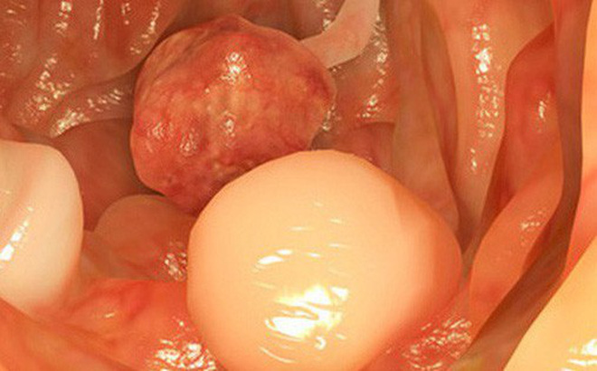 Nguyên PGĐ Bệnh viện K: Loại ung thư di truyền nhiều nhất, cần tầm soát sớm kẻo muộn-1