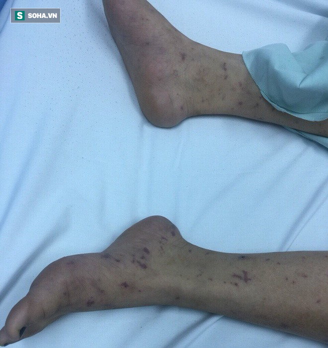 1 người mắc viêm não mô cầu khiến nhiều người phải cách ly: Bệnh này nguy hiểm thế nào?-1