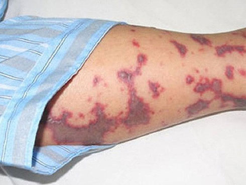 Chuyên gia Bệnh viện Nhi TƯ cảnh bảo biến chứng nguy hiểm của cúm mùa năm 2019-2