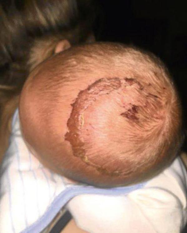 Sử dụng giác hút hỗ trợ khi đẻ thường, mẹ đau đớn nhìn con mang sẹo cả đời-3