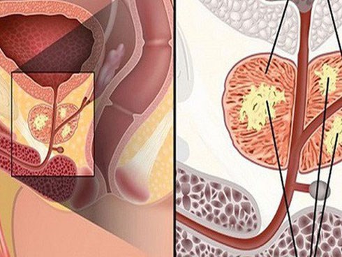 Yếu tố làm tăng nguy cơ mắc ung thư tuyến tiền liệt mà nam giới cần biết