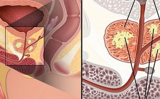 Yếu tố làm tăng nguy cơ mắc ung thư tuyến tiền liệt mà nam giới cần biết-3