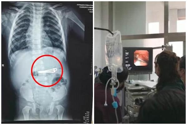 Bé 16 tháng nuốt gọn chiếc bấm móng tay vào bụng vì nghĩ rằng mẹ đùa với mình-2