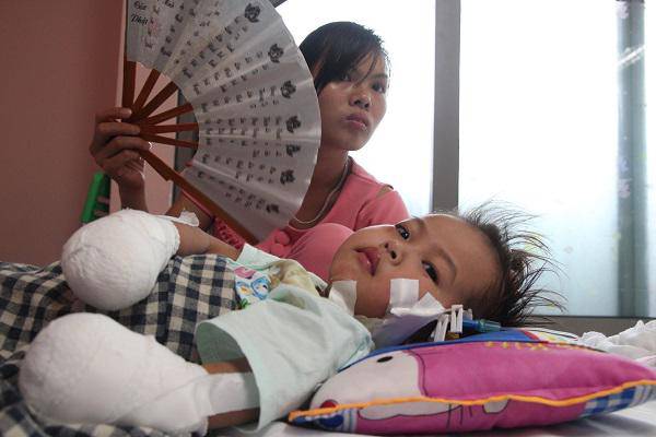 Mẹ bé gái tay chân hoại tử sau cơn sốt ban đêm: Thế là con mất hết tay, chân rồi”-3