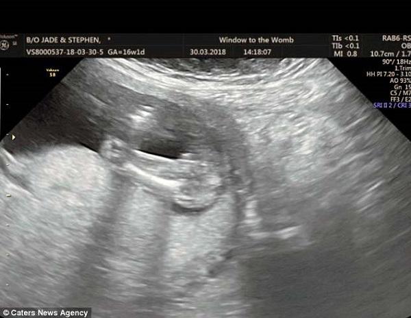Mẹ bầu phát hoảng” khi phát hiện hình ảnh siêu âm con trong bụng giống hệt… hình cậu nhỏ-2