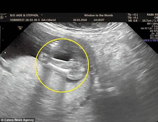 Mẹ bầu phát hoảng” khi phát hiện hình ảnh siêu âm con trong bụng giống hệt… hình cậu nhỏ-3