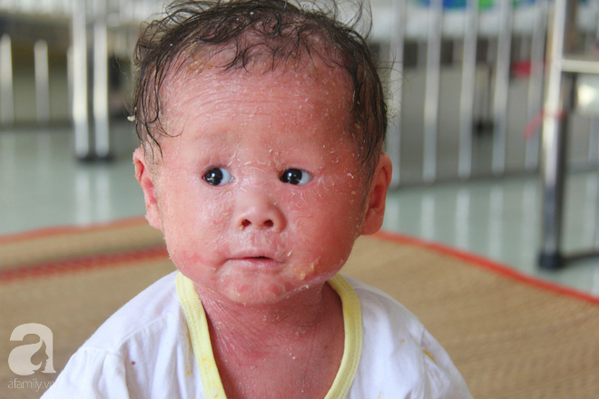 Người đầy vẩy ngứa như da trăn, bé gái 14 tháng tuổi bị bố mẹ bỏ rơi nên không có tiền chữa trị-2