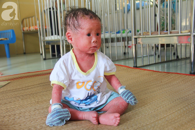 Người đầy vẩy ngứa như da trăn, bé gái 14 tháng tuổi bị bố mẹ bỏ rơi nên không có tiền chữa trị-11