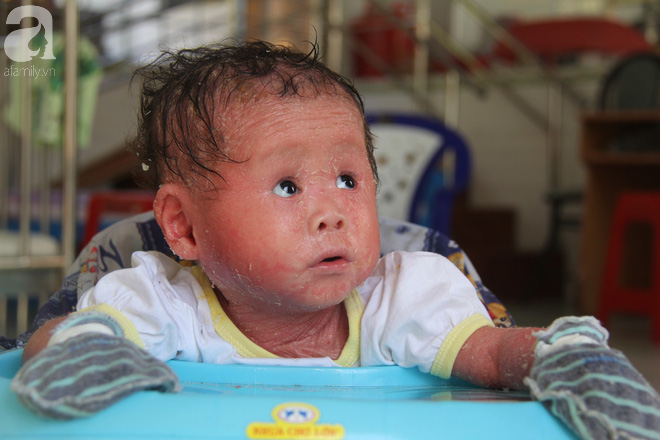 Người đầy vẩy ngứa như da trăn, bé gái 14 tháng tuổi bị bố mẹ bỏ rơi nên không có tiền chữa trị-13
