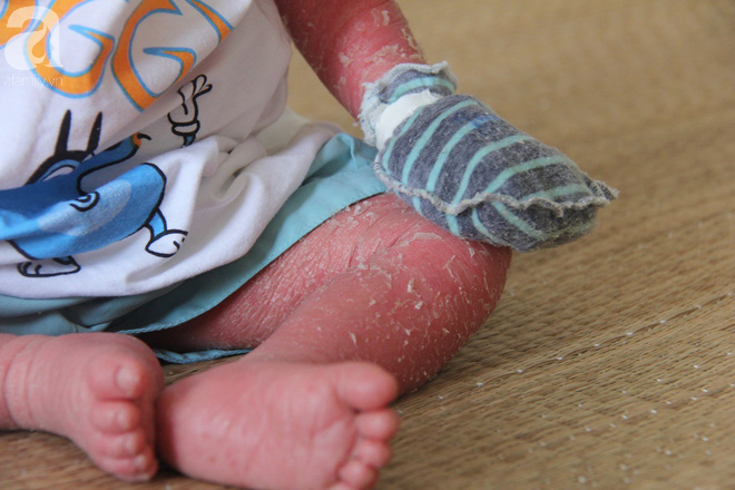 Người đầy vẩy ngứa như da trăn, bé gái 14 tháng tuổi bị bố mẹ bỏ rơi nên không có tiền chữa trị-14