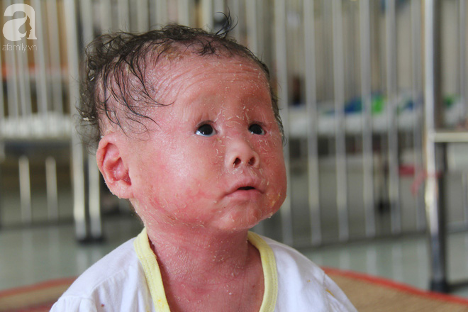 Người đầy vẩy ngứa như da trăn, bé gái 14 tháng tuổi bị bố mẹ bỏ rơi nên không có tiền chữa trị-15