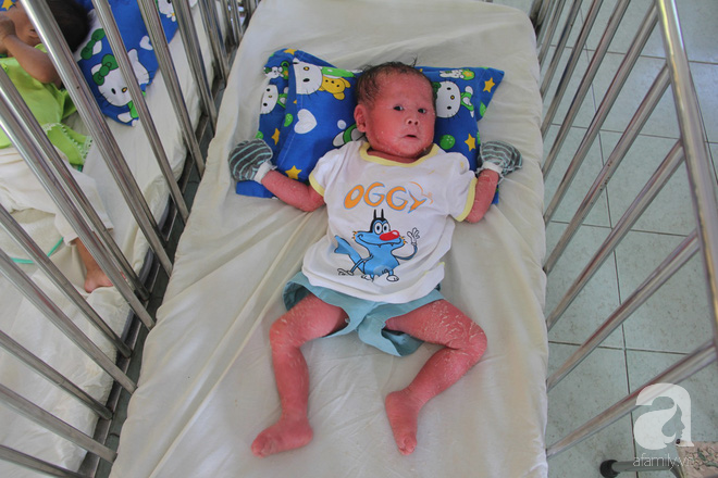 Người đầy vẩy ngứa như da trăn, bé gái 14 tháng tuổi bị bố mẹ bỏ rơi nên không có tiền chữa trị-16