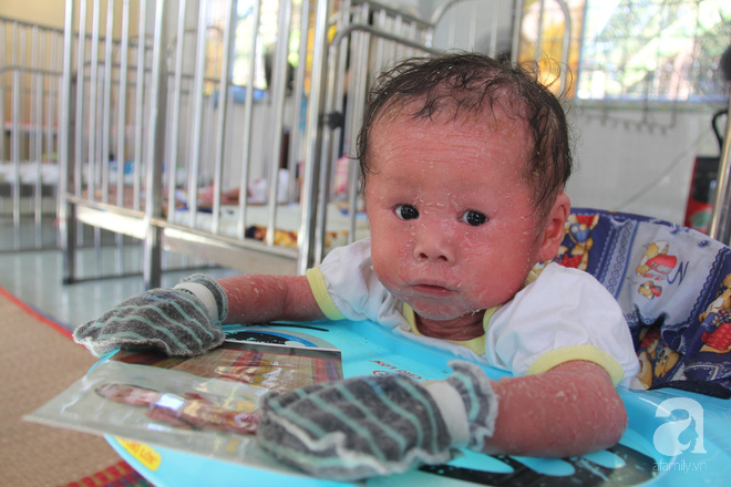 Người đầy vẩy ngứa như da trăn, bé gái 14 tháng tuổi bị bố mẹ bỏ rơi nên không có tiền chữa trị-3
