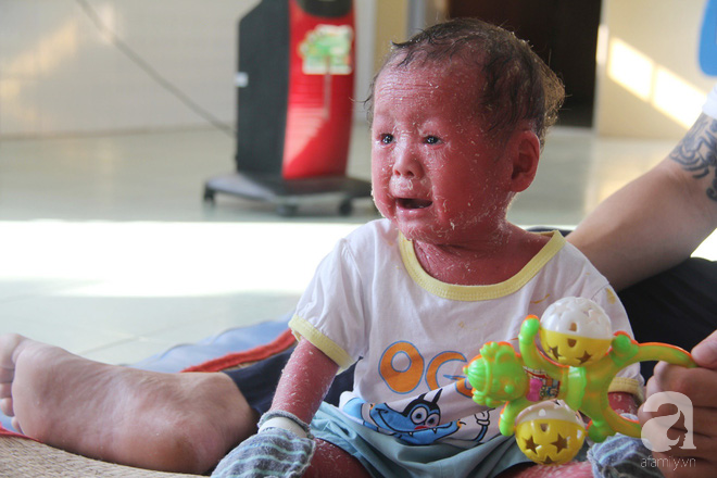 Người đầy vẩy ngứa như da trăn, bé gái 14 tháng tuổi bị bố mẹ bỏ rơi nên không có tiền chữa trị-6