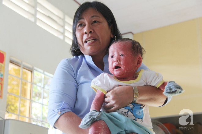 Người đầy vẩy ngứa như da trăn, bé gái 14 tháng tuổi bị bố mẹ bỏ rơi nên không có tiền chữa trị-7