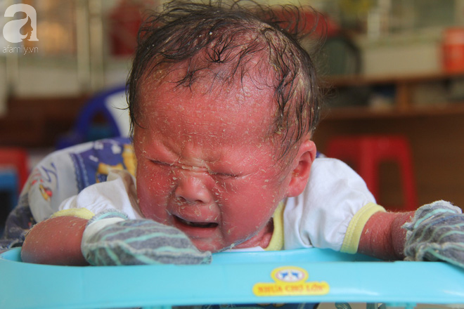 Người đầy vẩy ngứa như da trăn, bé gái 14 tháng tuổi bị bố mẹ bỏ rơi nên không có tiền chữa trị-10