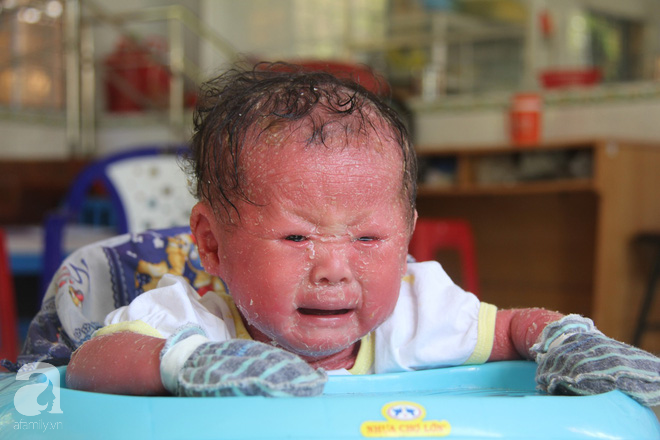 Người đầy vẩy ngứa như da trăn, bé gái 14 tháng tuổi bị bố mẹ bỏ rơi nên không có tiền chữa trị-1