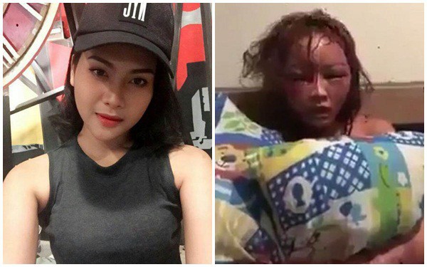 Cô gái bị bạn trai cuồng ghen livetream cảnh đánh đập, đốt tóc đến biến dạng mặt-1