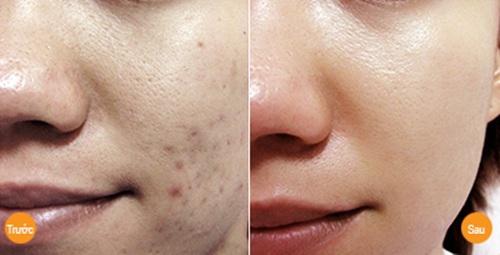 Sẹo thâm lâu năm cứng đầu đến mấy cũng phải đầu hàng với những mẹo dưới đây-6