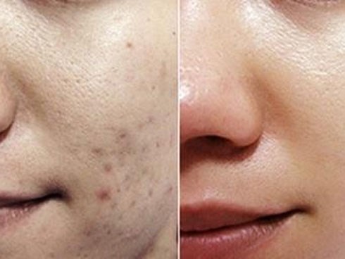 Sẹo thâm lâu năm cứng đầu đến mấy cũng phải đầu hàng với những mẹo dưới đây