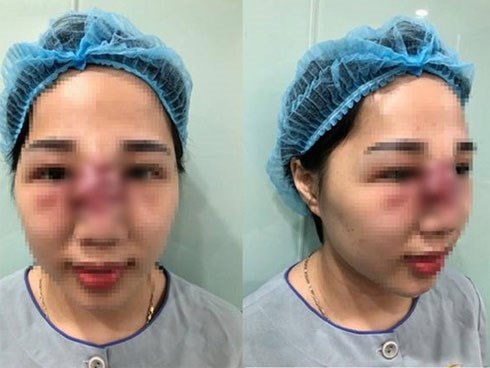 Làm đẹp bằng phương pháp tiêm filler: Cẩn thận “tiền mất, tật mang” khi ham giá rẻ