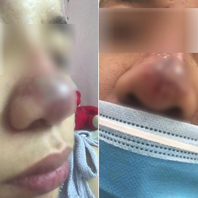 Làm đẹp bằng phương pháp tiêm filler: Cẩn thận tiền mất, tật mang” khi ham giá rẻ-2