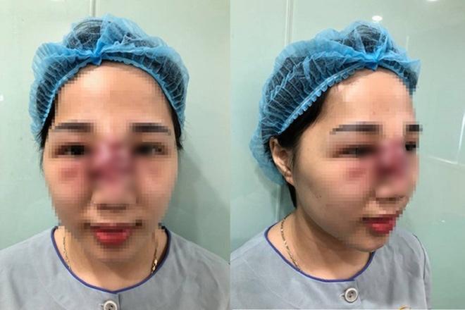 Làm đẹp bằng phương pháp tiêm filler: Cẩn thận tiền mất, tật mang” khi ham giá rẻ-3