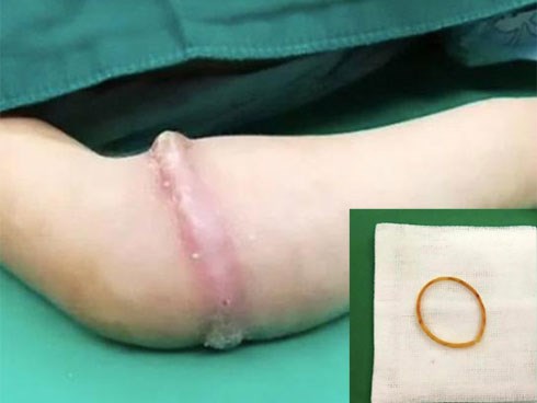 Bé gái 4 tuổi suýt mất một bên tay chỉ vì vật dụng nhỏ xíu nhà nào cũng có