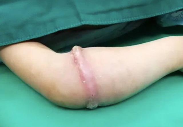 Bé gái 4 tuổi suýt mất một bên tay chỉ vì vật dụng nhỏ xíu nhà nào cũng có-1