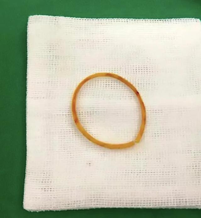 Bé gái 4 tuổi suýt mất một bên tay chỉ vì vật dụng nhỏ xíu nhà nào cũng có-4