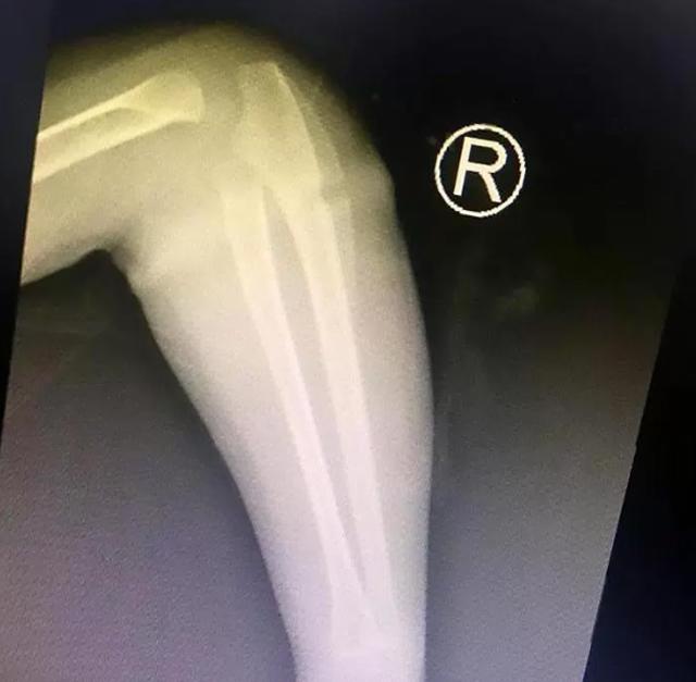 Bé gái 4 tuổi suýt mất một bên tay chỉ vì vật dụng nhỏ xíu nhà nào cũng có-2