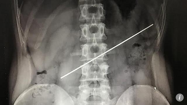 Người đàn ông dại dột nuốt thanh thép 20cm để nhận 18 triệu, lấy ra tốn gấp 4 lần-1