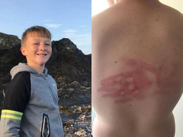 Người mẹ chết lặng khi biết sự thật đằng sau dấu tay in hằn trên lưng con trai-1