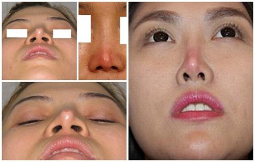 Phẫu thuật nâng mũi có ảnh hưởng gì không, đọc bài viết dưới đây bạn sẽ rõ!-5