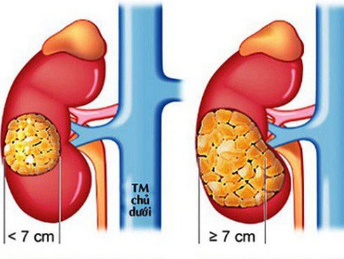 Nguyên nhân và triệu chứng ung thư thận