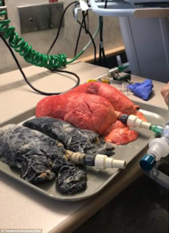 Hình ảnh phổi của một người khỏe mạnh và người hút thuốc lá suốt 20 năm khiến nhiều người hãi hùng-2