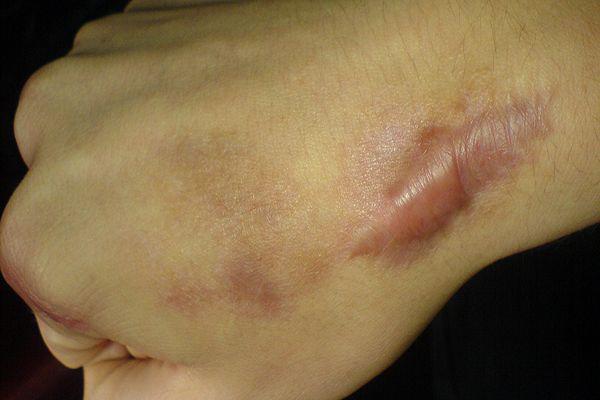 Xoá sẹo lồi cấp tốc nhờ 3 nguyên liệu rẻ, nhanh, gọn có thể thực hiện ngay tại nhà-1