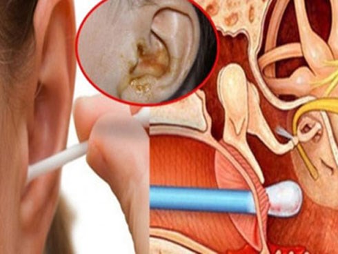Cảnh báo những nguy hiểm không ngờ của việc dùng tăm bông ngoáy tai hàng ngày