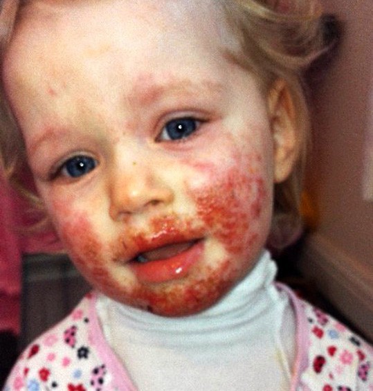 Bé gái bị lây bệnh tình dục vì nụ hôn của cha-2