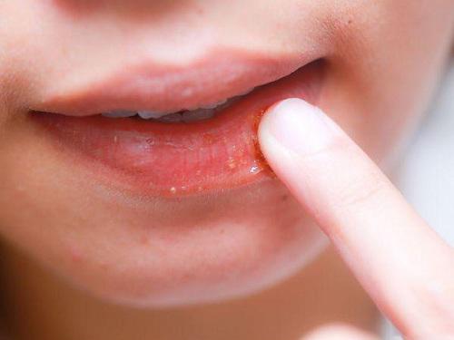 Với 5 ngàn đồng, chị em có ngay cách dưỡng môi bằng mật ong khỏi cần bôi son-2