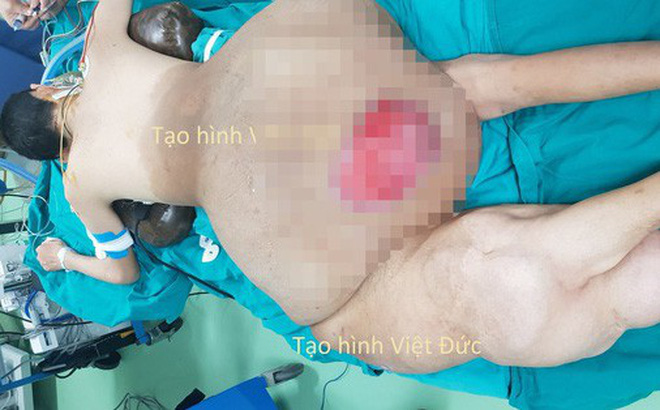 Bác sĩ choáng với khối u nặng 45 kg trên người nam thanh niên-1