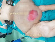 Bác sĩ 'choáng' với khối u nặng 45 kg trên người nam thanh niên