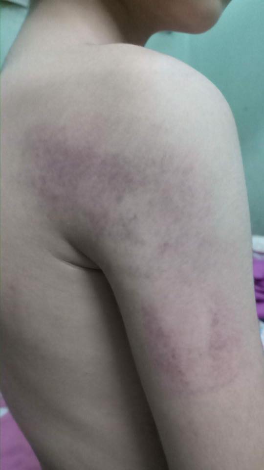 Cô giáo nhiều lần đánh học sinh lớp 1 bầm tay-1