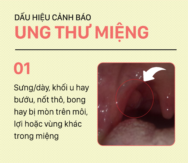 Đừng nhầm lẫn với bệnh ở miệng, đây là những dấu hiệu cảnh báo ung thư mà bạn nên nhớ-1