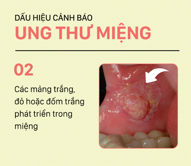Đừng nhầm lẫn với bệnh ở miệng, đây là những dấu hiệu cảnh báo ung thư mà bạn nên nhớ-2