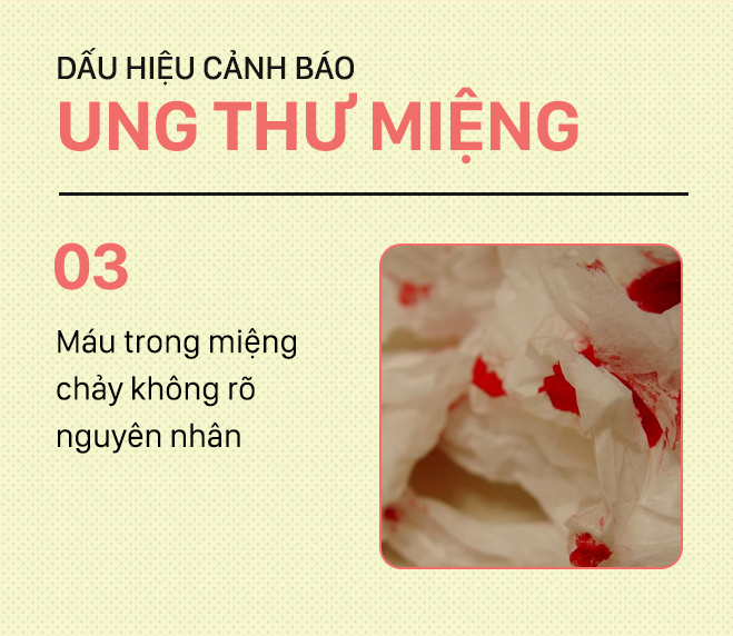 Đừng nhầm lẫn với bệnh ở miệng, đây là những dấu hiệu cảnh báo ung thư mà bạn nên nhớ-3